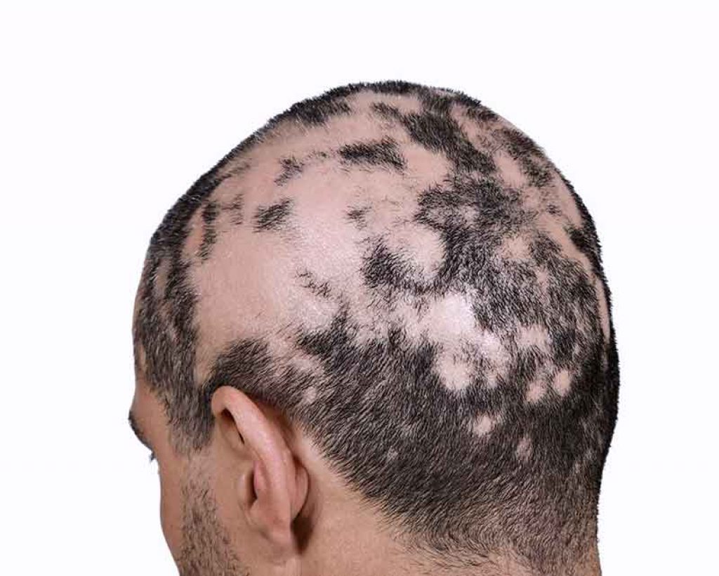 alopecia cure naturali