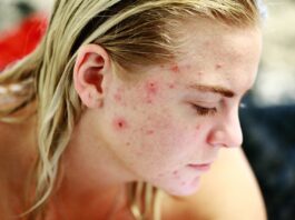 Acne: che cos’è e rimedi naturali acne-rimedi-naturali