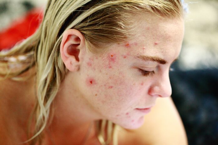 acne-rimedi-naturali