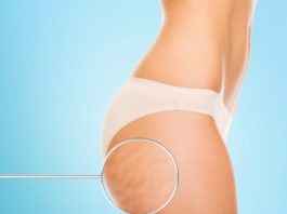 Quando la cellulite fa male: cause e rimedi naturali quando-la-cellulite-fa-male
