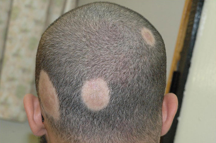 alopecia areata cure naturali