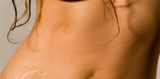 smagliature-cosa-sono-cause
