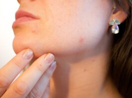 alimentazione-contro-acne