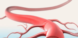 arteriosclerosi