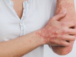 psoriasi-cause