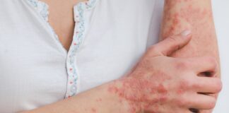 Psoriasi: cos’è, cause e rimedi naturali psoriasi-cause