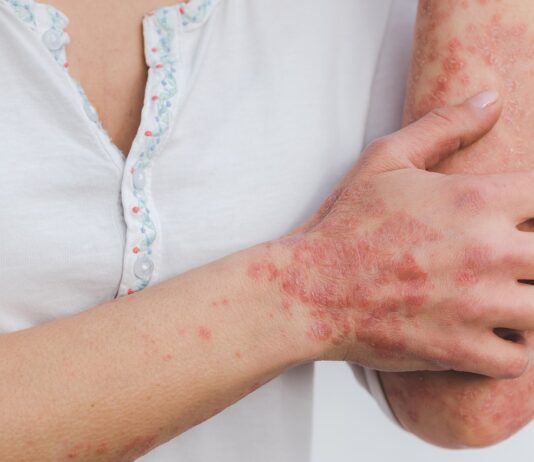 psoriasi-cause