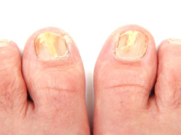 Pedicure con candeggina: perché si fa? pedicure con candeggina