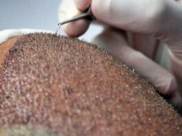 trapianto capelli turchia