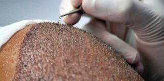 trapianto capelli turchia