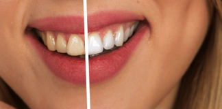 lavare i denti prima o dopo colazione