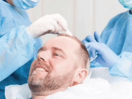 Trapianto capelli