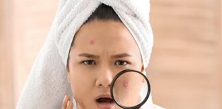 Rimedi contro l'acne