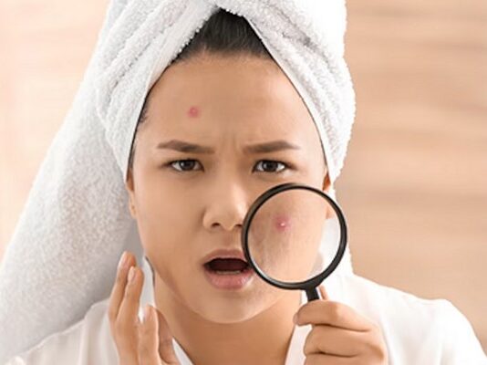 Rimedi contro l'acne