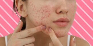 Acne cistica