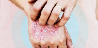 Psoriasi