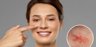 Vene varicose sul naso e rosacea: come trattarle? Vene varicose sul naso e rosacea